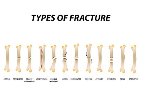 Types Of Fracture Fracture Bone Set Infographics Vector Illustration On