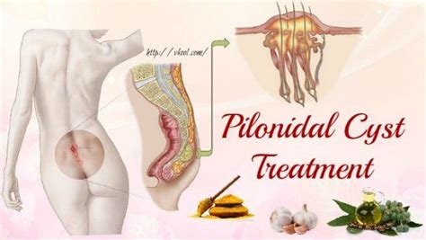 Tips Of Natural Pilonidal Cyst Treatment You Should Know