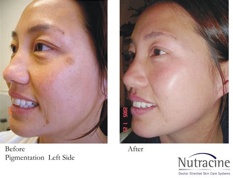 Before And After Nutracine Skin