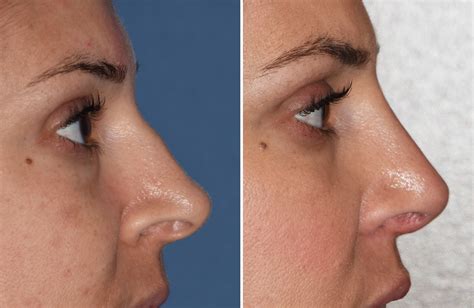 Rhinoplasty For Long Thin Nose Results Side View Dr Barry Eppley