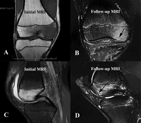 Osteochondral Injury Medial Femoral Condyle