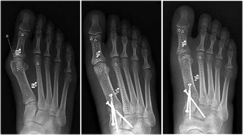 Clinical And Imaging Assessment And Treatment Of Hallux Valgus Nathan