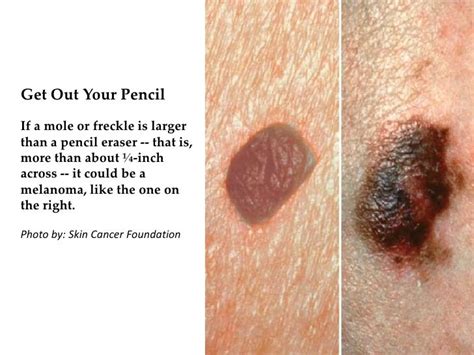 How To Tell If A Mole Or Freckle Is Cancerous Cancerwalls