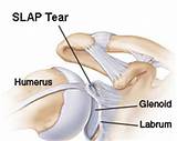Photos of Labral Tear Shoulder Treatment Options