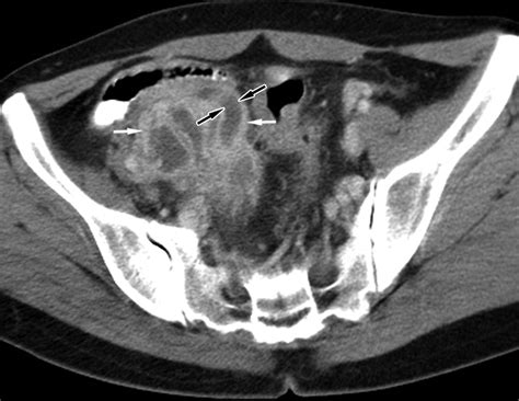 Unusual Causes Of Tubo Ovarian Abscess Ct And Mr Imaging Findings