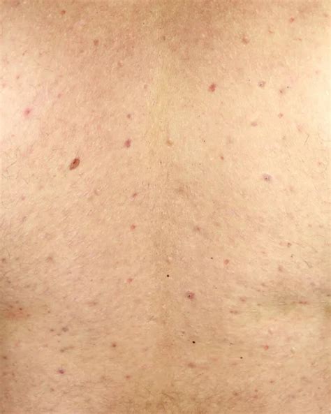 Acne Skin Skin Problem Many Acne Shoulders Rear View
