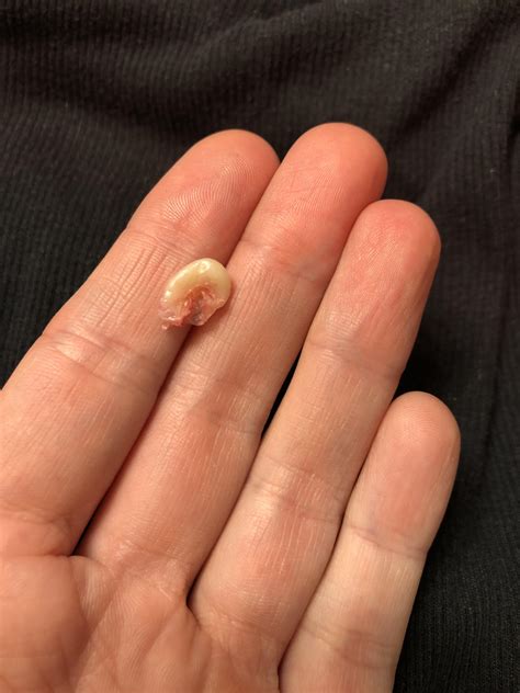 Sebaceous Cyst Just Pulled This Out Of My Head With Tweezers Made A Nice Little Pop Rpopping