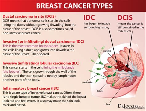 Breast cancer can spread outside the breast through blood vessels and lymph vessels. 12 Natural Strategies to Prevent Breast Cancer - DrJockers.com