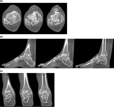 Commentary On The Paper “hindfoot Malalignment In Adults With