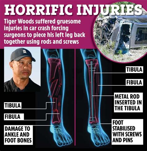 Tiger Woods ‘may Never Get Mobility Back And Narrowly Avoided His Leg