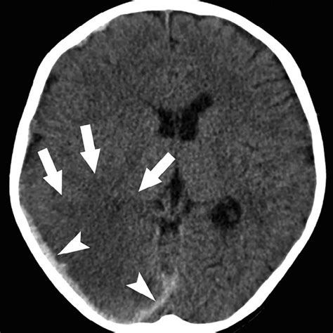 Pdf Unilateral Anoxic Brain Injury Secondary To Strangulation