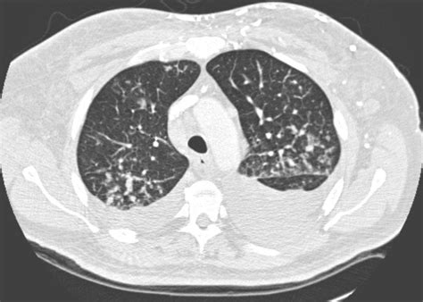 Ct scans for pleural effusion should be performed with contrast enhancement of the pleura and before complete drainage of pleural fluid. Axial CT of the mid thorax with lung window settings ...