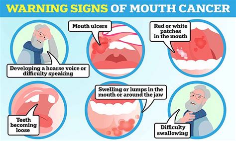 Warning Signs Of Mouth Cancer Revealed As Charity Warns Nhs Dental Crisis May Be Fuelling Spike