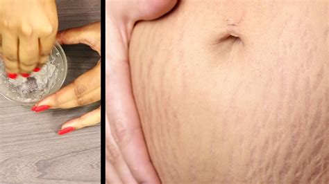 Stretch Marks During Pregnancy Stretch Marks Removal After Pregnancy