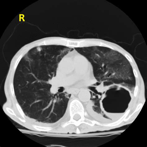 Lung Abscess Radiology