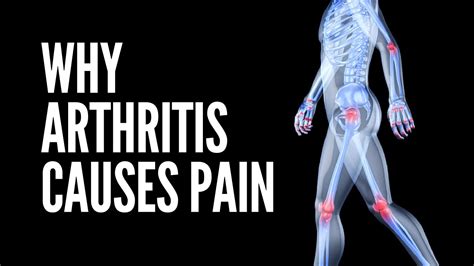 What Is Arthritis What Causes Arthritis Why Arthritis Causes Pain