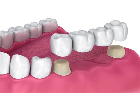 Crowns And Bridges Sarum Dental Practice Salisbury Dentist