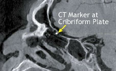 Sagittal image illustrating avoidance of the cribriform ...