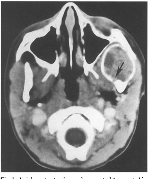 Figure 1 From Pediatric Mandibular Aneurysmal Bone Cyst Semantic Scholar