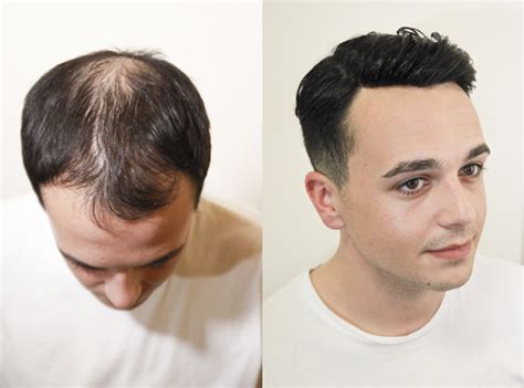 Male Pattern Baldness Hairstyle For Thin Hair Male Latest Hairstyle