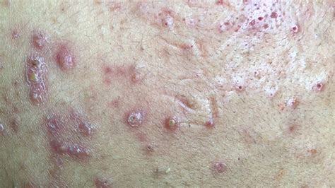 Awesome Inflamed Blackheads Field Full Treatment 46m 30s