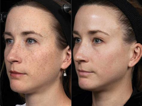 Fraxel Laser Treatment For Acne Scars Before And After