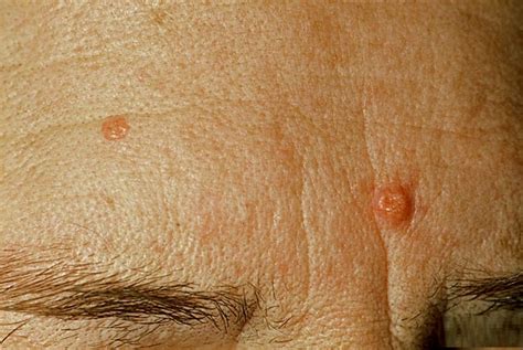 Sebaceous Hyperplasia Causes Pictures Symptoms Treatment Healthmd