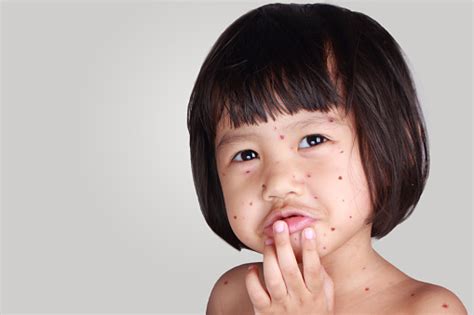 Little Girl With Smallpox Stock Photo Download Image Now Chickenpox