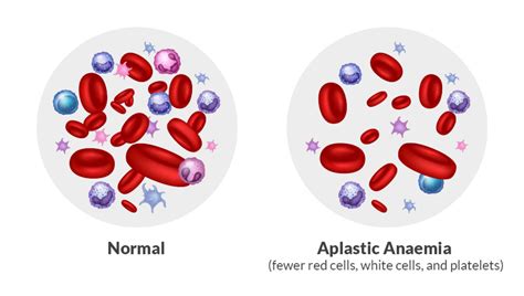 Download Free 100 Aplastic Anemia Wallpapers