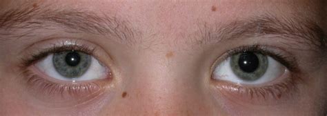 Pupil Size Anisocoria Horners Aides Eye Surgery Ltd