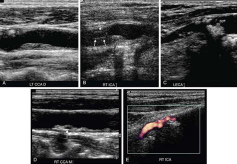 Ultrasound Evaluation Of The Carotid Arteries Radiology Key