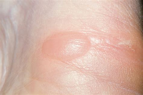 How Long Does It Take For A Popped Blister To Heal Hill Sincing