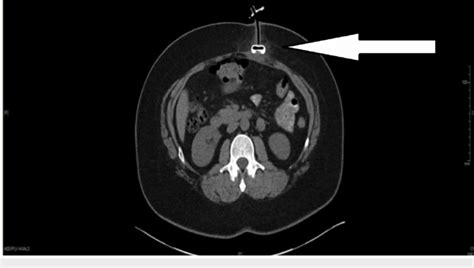 Ct Scan Of The Abdomen Without Contrast Showing Retraction Of The