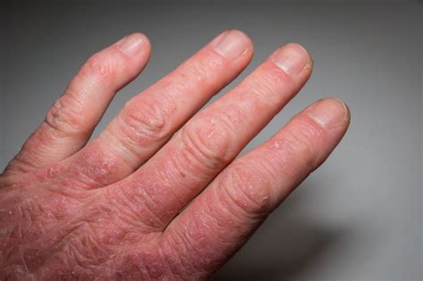 Clinical Features Of Psoriatic Arthritis Rheumatische Arthritis