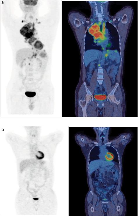 Petct In Oncology Rcp Journals