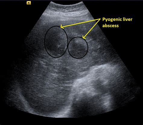 Pyogenic Liver Abscess Ultrasound Wikidoc