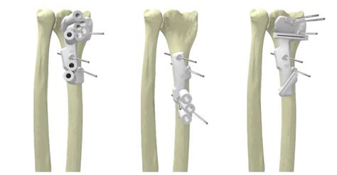 Lima And Materialises Knee Surgery Guides 3d Printing Industry