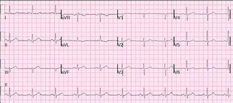 1 online resource (xii, 132 pages) : Dr. Smith's ECG Blog: A Case of Clinical Unstable Angina ...