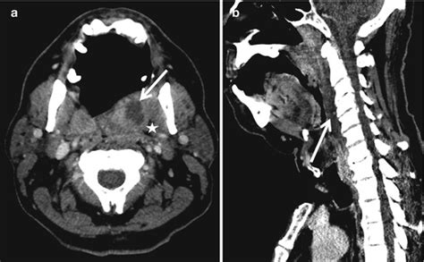 Oral Cavity And Oropharynx Radiology Key