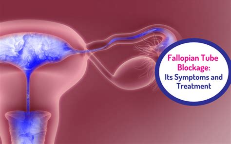 Blocked Fallopian Tubes Symptoms Treatment Causes Gadget