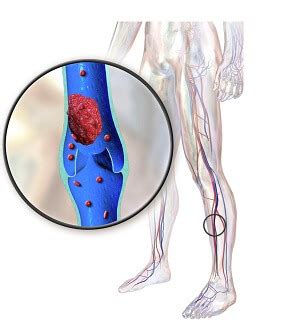 Along with immobility, a hyperextended knee can also make it difficult for you to walk at all. Pain Behind The Knee: Diagnosis & Treatment - Knee Pain ...