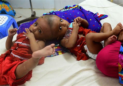 Bangladesh Performs First Conjoined Twin Surgery Health News Asiaone