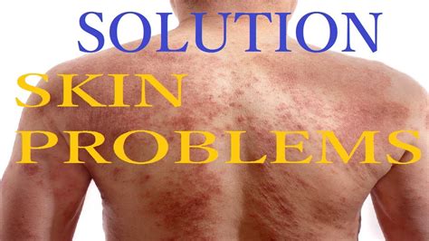 Solution For Skin Problems Snhealthcare Youtube