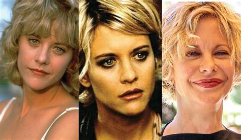 Meg Ryan Plastic Surgery Before And After Photos Lip