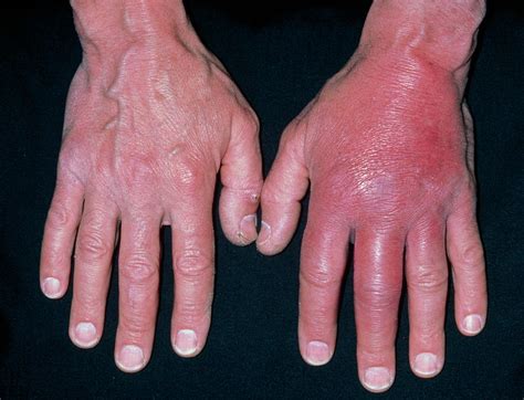 Inflammation Of Hand Due To Cellulitis Photograph By Dr P Marazzi