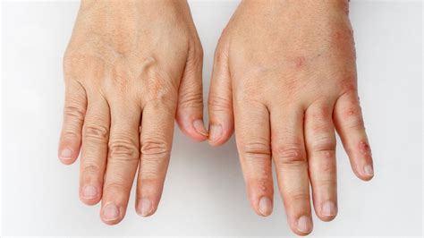 Mãos inchadas 8 possíveis causas e o que fazer Clínica Dra Juliana Toma