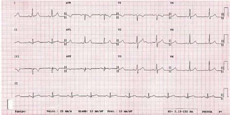 Electrocardiograma De 12 Derivaciones De La Taquicardia De Qrs Ancho