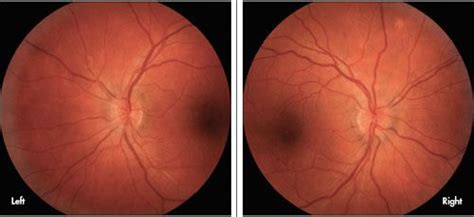 A 36 Year Old Man Had Noticed A Dark Spot In The Field Of Vision Of His