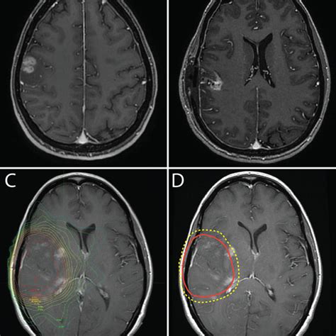 A T1 Weighted Contrast Enhanced Mri Of The Brain Demonstrating An