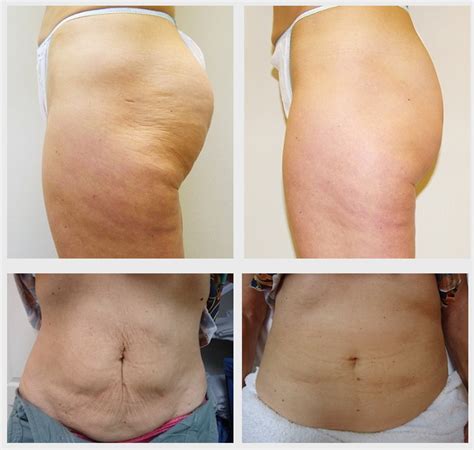 How To Smooth Cellulite And Tighten Skin In 2 Easy Steps Feel Good Laser And Skin